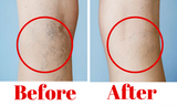 Varicose Veins Treatment Cream Varicosity Angiitis Remedy Ointment Relief Veins Pain