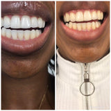 44% Peroxide Teeth Whitening Kit